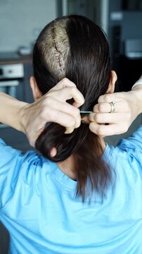 Woman with partially shaved head tying hair in ponytail revealing surgical scar after brain tumor removal. Oncology recovery and body acceptance concept.