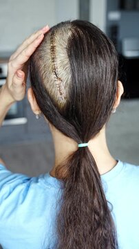 Woman with visible surgical scar after brain cancer surgery. Brain tumor treatment, oncology recovery and survival concept.