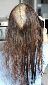 Woman carefully combing hair near surgical scar with staples after craniotomy for brain tumor removal. Postoperative care and recovery routine concept.