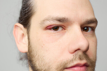 Fototapeta premium Swollen red eyelid close-up, eye inflammation or stye, medical condition