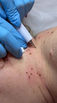 Close up video of papilloma removal on neck using electrocoagulation device. Doctor cauterizes skin growth with heated electrode, creating precise burn effect, medical dermatology procedure. 