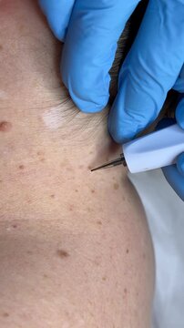 Surgery concept. Papillomas removal. Close up. Doctor removing mole in surgical procedure by burning it with medical tools and equipment on male body. High quality 4k footage