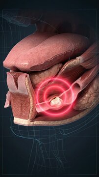 Salivary Gland Stone Obstruction Animation Showing Sialolithiasis and Pain in the Submandibular Duct