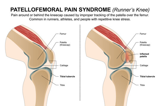 Patellofemoral Pain Syndrome (Runner&rsquo;s Knee)