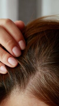 Close-up of stress-induced graying, early signs of gray hair on scalp and hairline.