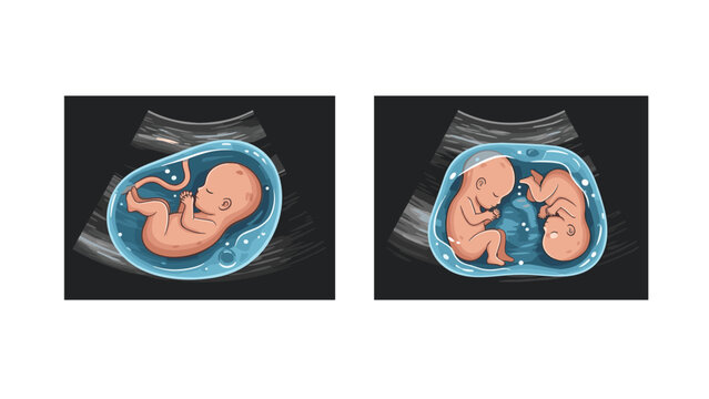 Prenatal ultrasound scan comparison showing the difference between a single fetus and twin fetuses in the mother womb.