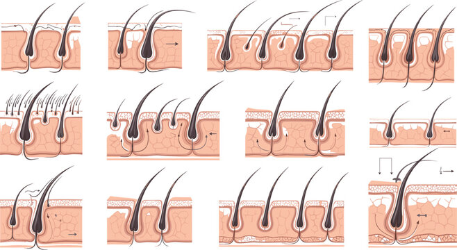 Hair follicle anatomy vector set showing skin layers growth cycle and hair structure detailed medical illustration for dermatology education
