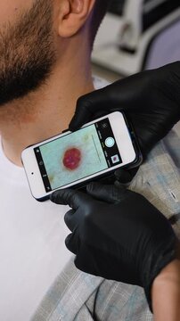 Dermatologist examining patient's mole with smartphone dermatoscope