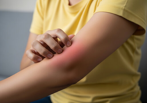 Woman in yellow shirt scratching her arm due to mosquito bite causing