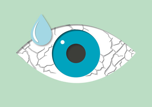 Dry eye syndrome, conceptual illustration