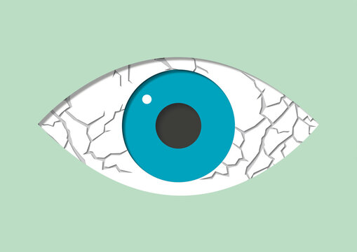 Dry eye syndrome, conceptual illustration