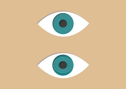 Astigmatism, illustration