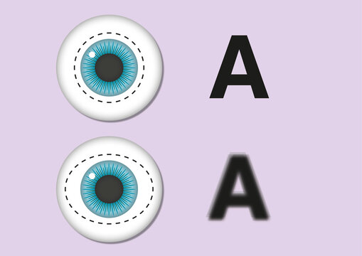 Astigmatism, illustration