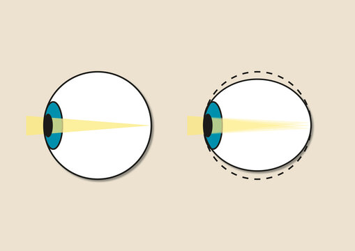 Astigmatism, illustration