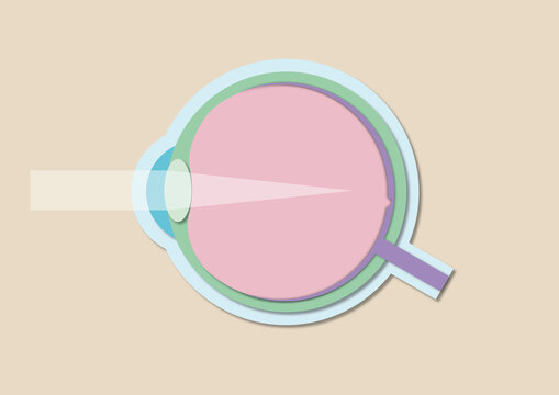 Short-sightedness, illustration