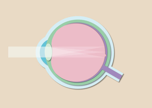 Astigmatism, illustration