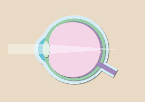 Long-sightedness, illustration