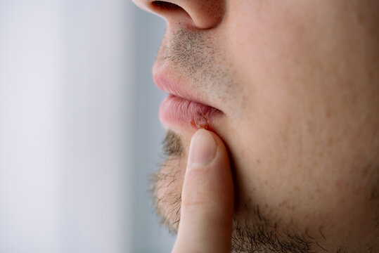 Man's finger gently touching a visible cold sore on his lower lip, illustrating the uncomfortable symptoms of oral herpes simplex virus affecting the mouth area