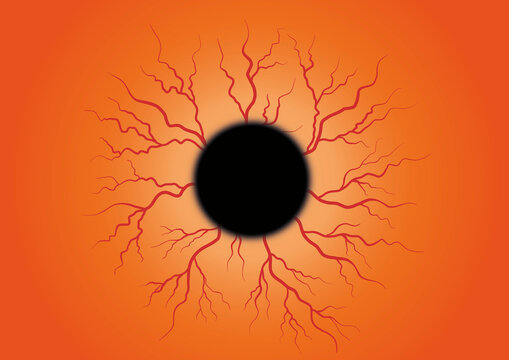 Subconjunctival haemorrhage, conceptual illustration