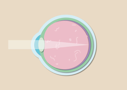 Retinopathy, illustration