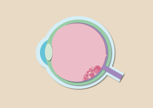 Retinoblastoma, illustration
