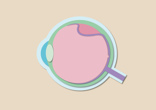 Retinal detachment, illustration