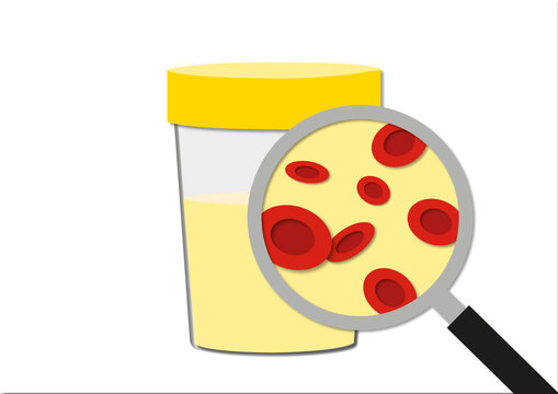 Blood in urine, conceptual illustration