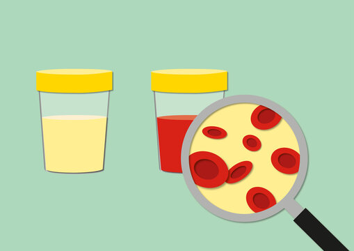 Blood in urine, conceptual illustration
