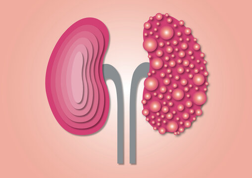 Polycystic kidney disease, conceptual illustration