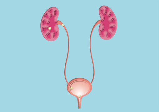 Kidney stones, conceptual illustration