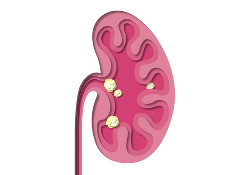Kidney stones, conceptual illustration
