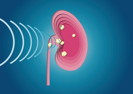 Shockwave therapy for kidney stones, conceptual illustration