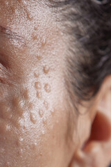 Injectable cosmetology. Facial biorevitalization procedure using a hyaluronic acid-based product. Papules on female face after biorevitalization. close-up