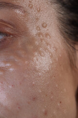 Injectable cosmetology. Facial biorevitalization procedure using a hyaluronic acid-based product. Papules on female face after biorevitalization. close-up