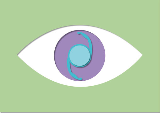 Intraocular lens, conceptual illustration