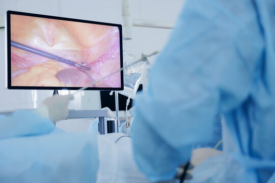Monitor displaying laparoscopic view during abdominal surgery to remove uterus and ovarian appendages in woman due to cancer