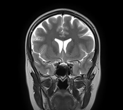 Normal brain MRI, coronal T2-weighted image showing cerebral hemispheres, cortex, lateral ventricles, basal ganglia, thalami, temporal lobes and sphenoid sinus.