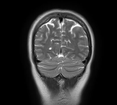 Normal brain MRI, coronal T2-weighted image showing cerebral hemispheres, cerebral cortex, cerebellum, cerebellar hemispheres, vermis and posterior fossa.