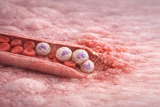 Neutrophil Extravasation During Acute Inflammation Concept