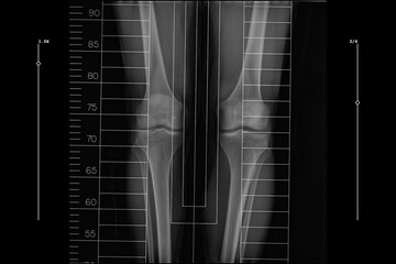 full length standing scanogram of the bilateral lower limbs, captured from the pelvis to the ankle with integrated rulers to assist in orthopedic analysis for limb length measurement and alignment © ATRPhoto
