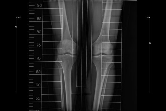 full length standing scanogram of the bilateral lower limbs, captured from the pelvis to the ankle with integrated rulers to assist in orthopedic analysis for limb length measurement and alignment