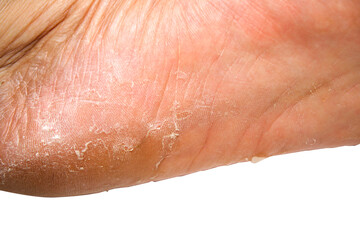 Fototapeta premium Close-Up View of Dry Skin on Human Foot Sole with Visible Cracks