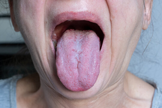 Langue fissur&eacute;e et mycose