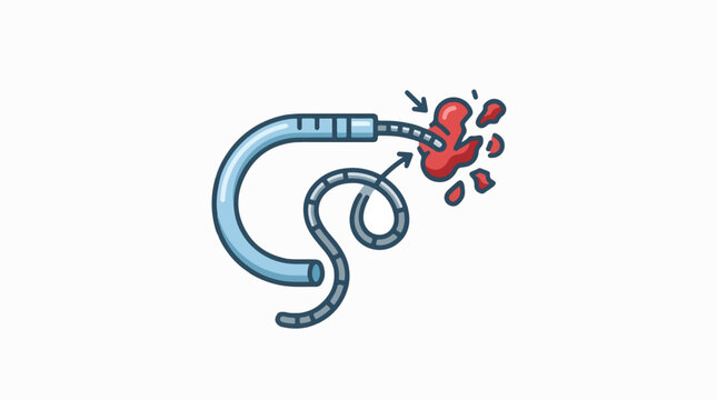 Medical illustration of a catheter-based procedure, showing a blue catheter and a flexible wire fragmenting a red mass, suggesting stone or clot removal.