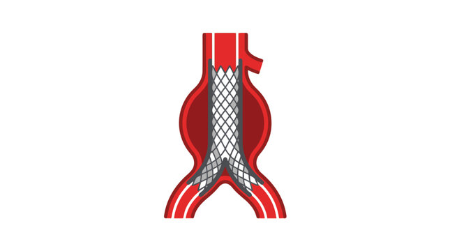 An illustration of an endovascular stent graft placed within an abdominal aortic aneurysm (AAA) to reinforce the weakened vessel wall and restore healthy blood flow.