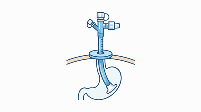 Medical illustration of a gastrostomy tube (G-tube) inserted through the abdominal wall into the stomach. It shows an external port and an internal retention device, typically for enteral fe