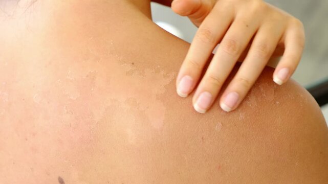 Peeling skin flakes appear on a shoulder while a hand lightly touches the dry irritated area in close-up. The footage illustrates sunburn recovery and skin damage from UV exposure, useful for