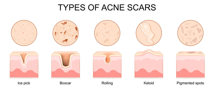 Types of acne scars. Cross section of human skin after treatment acne pimples.