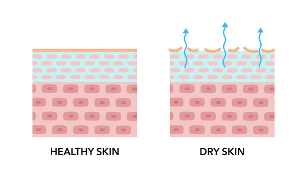 The mechanism of dry skin vector illustration isolated on white background. Cross section of lack of natural oil on skin layer causes more transepidermal water loss. Skin care and beauty concept.