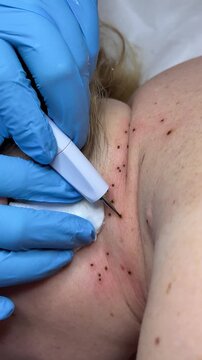 Preparing procedure for medical surgery. Laser skin tags removal. Skin Tags on Neck. Cancer papilloma on the skin wart close up. remove papillomas